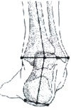 Superfeet Comfort Hockey Skate Footbeds